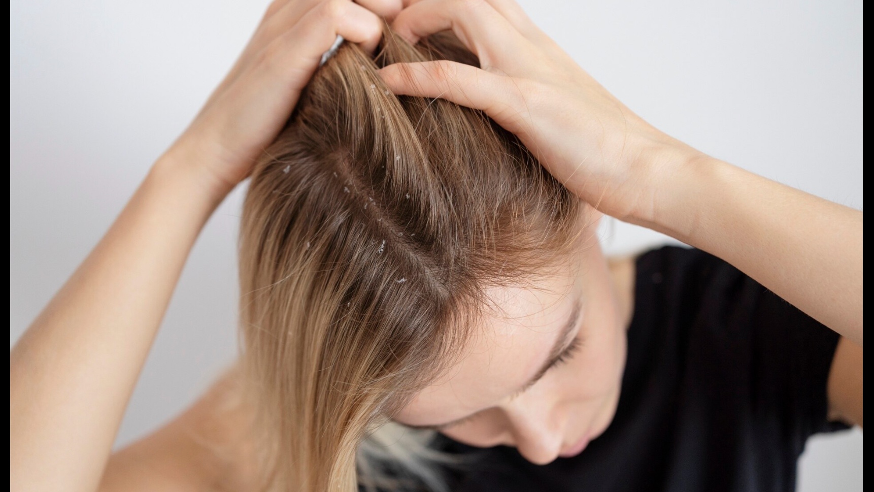 Pellicules, démangeaisons, cuir chevelu sensible : comment apaiser durablement
